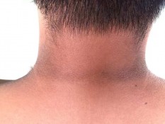 ⁠Tips Sehat, Cara Mengatasi Lipatan Hitam Kulit