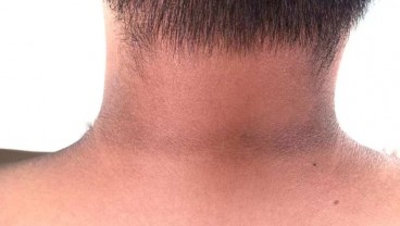 ⁠Tips Sehat, Cara Mengatasi Lipatan Hitam Kulit