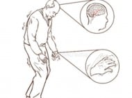 Pria 2 Kali Lebih Berisiko Terkena Parkinson Dibandingkan Perempuan