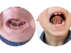 Tongue Tie Sebabkan Anak Terlambat Bicara, Mitos atau Fakta?