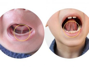 Tongue Tie Sebabkan Anak Terlambat Bicara, Mitos atau Fakta?