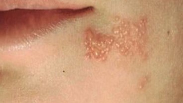 Vaksin Herpes Zooster Bisa Kurangi Risiko Sakit Jantung