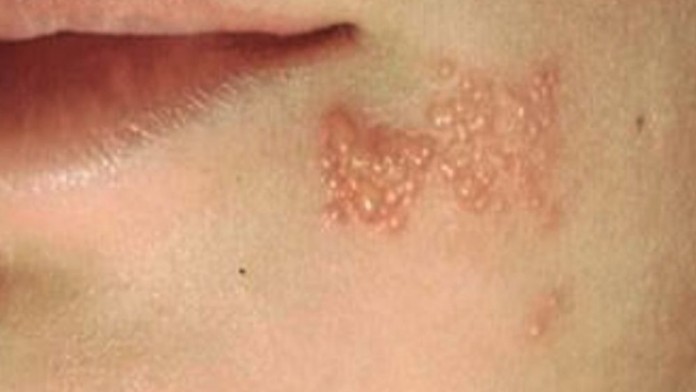 Vaksin Herpes Zooster Bisa Kurangi Risiko Sakit Jantung
