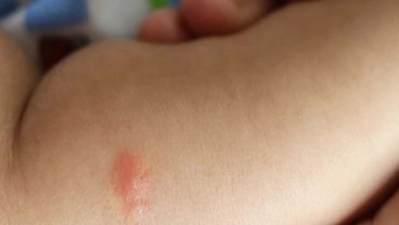 Bisakah Alergi Terhadap Makanan Disembuhkan?
