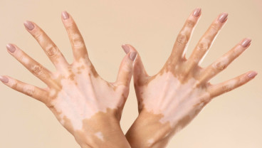 Neurofibromatosis Tipe 1, Penyakit Langka yang Tidak Bisa Diabaikan