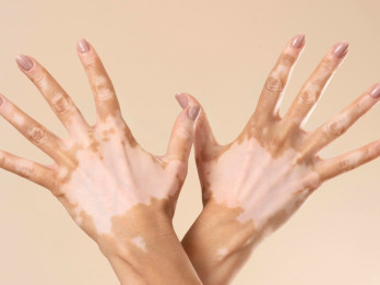 Neurofibromatosis Tipe 1, Penyakit Langka yang Tidak Bisa Diabaikan