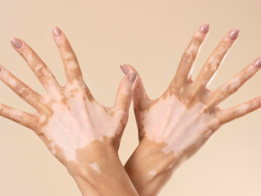 Neurofibromatosis Tipe 1, Penyakit Langka yang Tidak Bisa Diabaikan