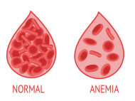 Mengenal Gejala Anemia Sel Sabit, Anemia Akibat Kelainan Genetik