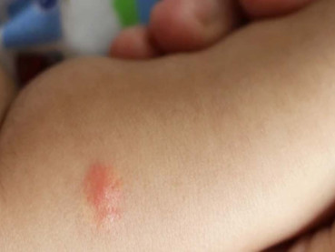 Kenali Gejala Cacar Api dan Cara Mencegahnya