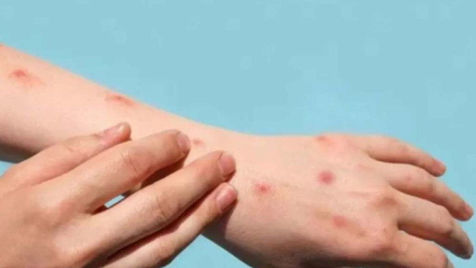 Kenali Cara Mencegah dan Mengatasi Penyakit Campak