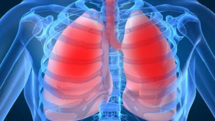 Penyakit Pneumonia yang Paling Banyak Ditangani Tim Evakuasi Haji