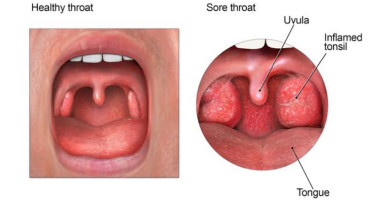 Mengenal Manfaat Gypsum Fibrosum dan Calcitum, Bisa Redakan Panas Dalam pada Anak