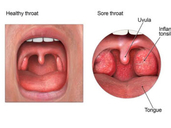 Mengenal Manfaat Gypsum Fibrosum dan Calcitum, Bisa Redakan Panas Dalam pada Anak