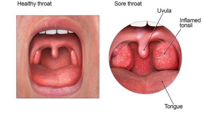 Mengenal Manfaat Gypsum Fibrosum dan Calcitum, Bisa Redakan Panas Dalam pada Anak