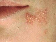 Tips Sehat, Cara Tepat Mencegah Herpes Zoster