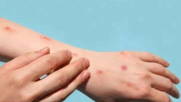 Awas Komplikasi Cacar Api, Bisa Sebabkan Risiko Penyakit Jantung dan Stroke