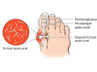 Penyebab Kadar Asam Urat Tinggi dan Cara Menurunkannya Secara Alami