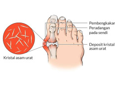 Penyebab Kadar Asam Urat Tinggi dan Cara Menurunkannya Secara Alami