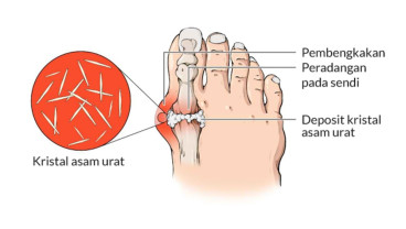 Penyebab Kadar Asam Urat Tinggi dan Cara Menurunkannya Secara Alami