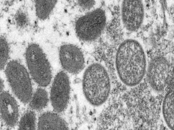 Kenali Gejala MPox dan Kelompok yang Paling Berisiko