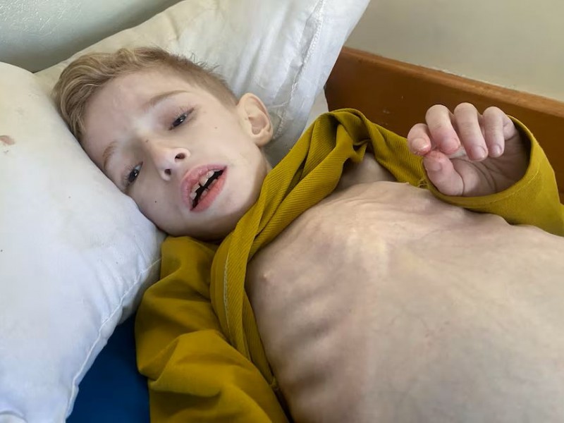 Fadi al-Zant, anak Palestina yang mengalami malnutrisi terbaring di tempat tidur di rumah sakit Kamal Adwan, 10 Maret 2024./Reuters