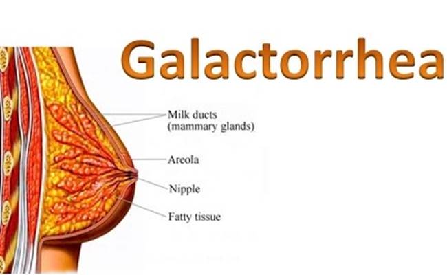 Galaktorea : Puting Payudara Mengeluarkan Cairan, Cermati Hal ini