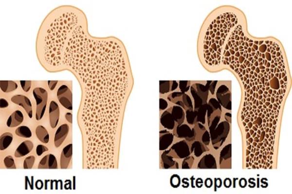 Manfaat Suplemen Vitamin D untuk Kesehatan Tulang Dipertanyakan