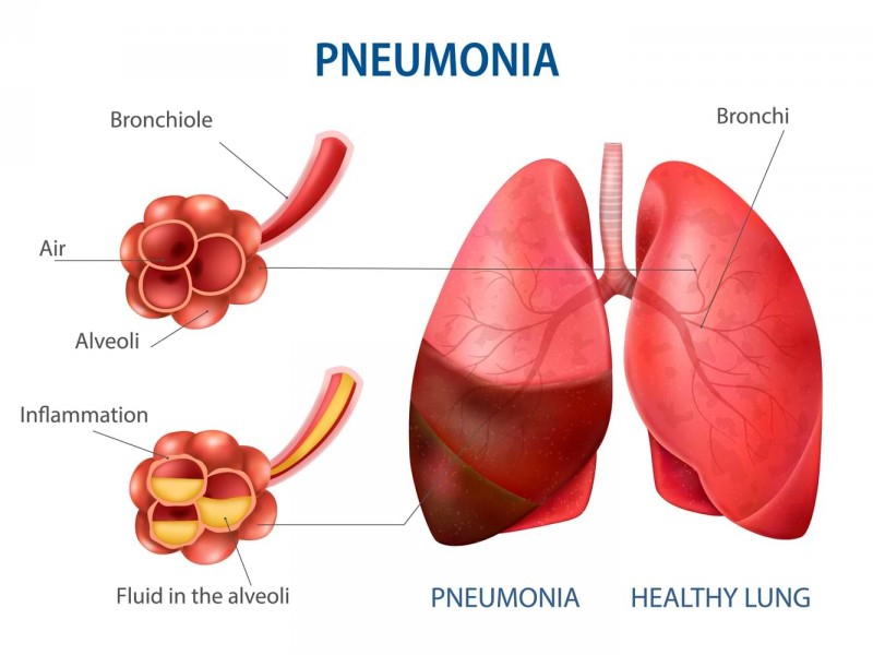 Pneumonia - Prostasia.id