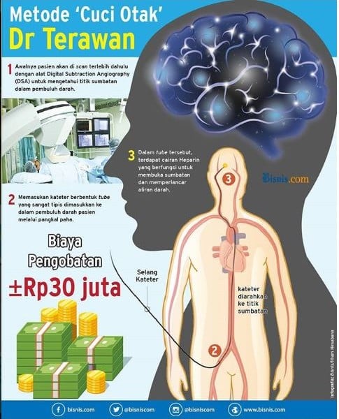 Seluk-Beluk Stroke, Begini Penanganan yang Benar