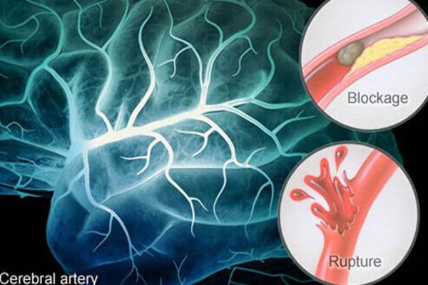 Tidur Lebih dari 9 Jam Semalam? Hati-Hati Risiko Stroke