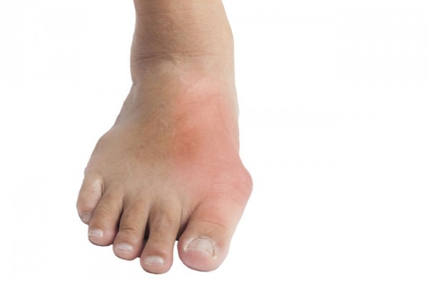 gejala asam urat di kaki